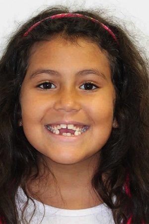 Girl with large gaps between teeth before orthodontics