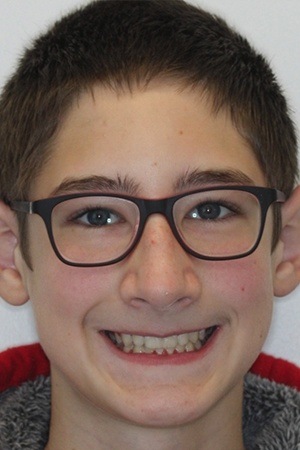 Teen boy with aligned teeth after braces