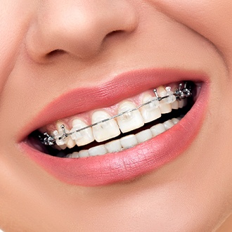 Closeup of teeth with cler and ceramic adult orthodontics