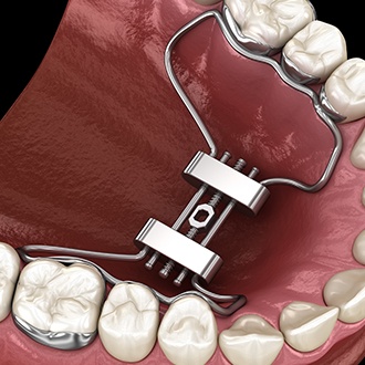 Animated smile with dentofacial orthopedic device