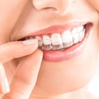 An up-close view of a woman inserting her Invisalign aligner into the upper part of her mouth