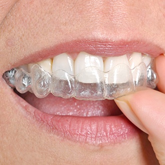 a patient wearing their Invisalign aligner
