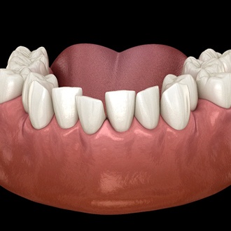 Graphic of overcrowded teeth