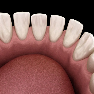 Graphic of gapped teeth