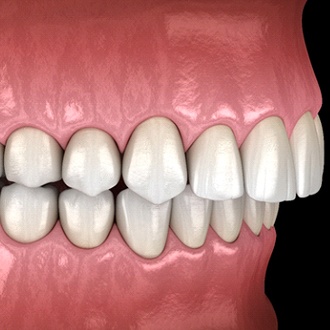 Graphic of overbite