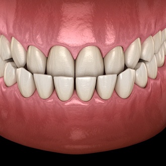 Graphic of underbite