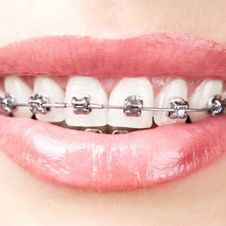 Closeup of teeth with self ligating braces
