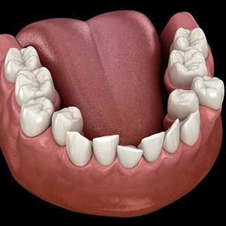 Illustration of crowded teeth