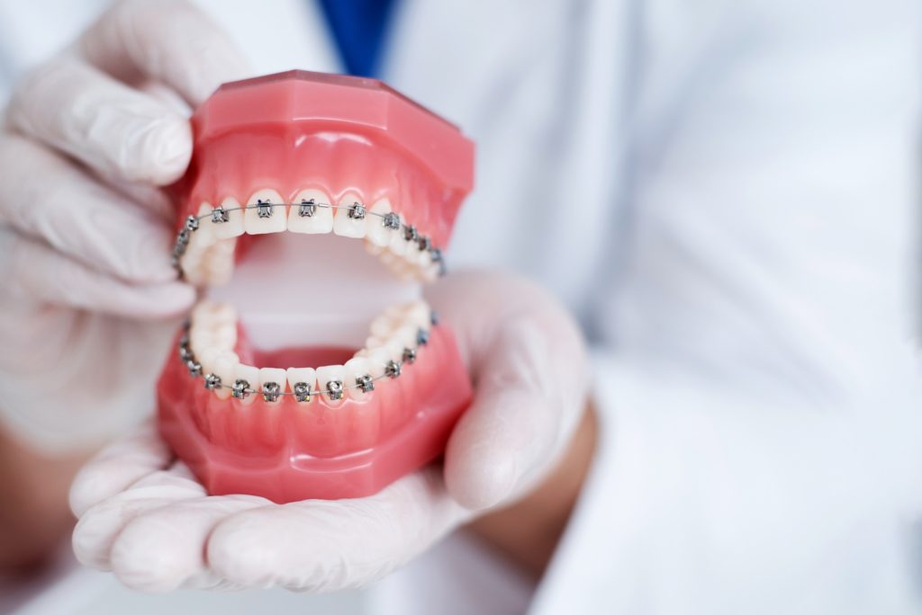 Orthodontist holding model of teeth with braces